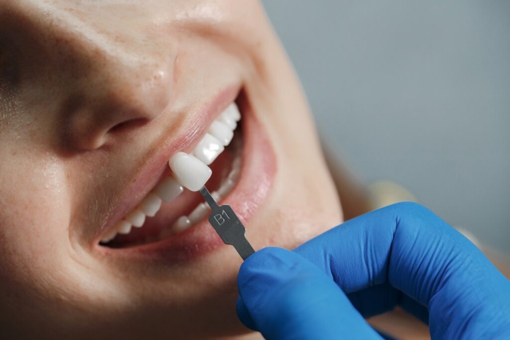 Exploring Dental Veneers: A Comprehensive Guide to Enhancing Your Smile